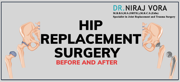 Hip Replacement Surgery Before and After | Dr Niraj Vora