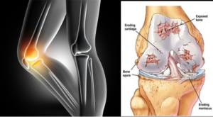 Knee Joint & Osteoarthritis Comparison