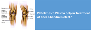 Platelet-Rich Plasma help in Treatment of Knee Chondral Defect