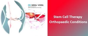 Stem cell therapy for knees