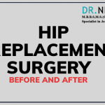 Hip Replacement Surgery Before and After | Dr Niraj Vora | Dr Niraj Vora