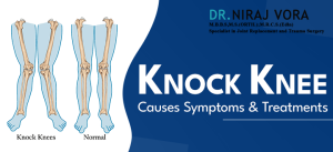 Knock Knee Causes Symptoms and Treatments | Dr Niraj Vora